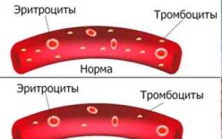 Гестационная тромбоцитопения мкб код