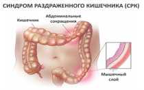 Синдром раздраженной толстой кишки по мкб