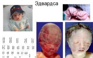 Фото больного с синдромом эдвардса