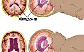 Что такое признаки гипертензионного синдрома