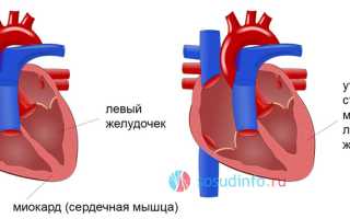 Синдром спортивного сердца у подростков