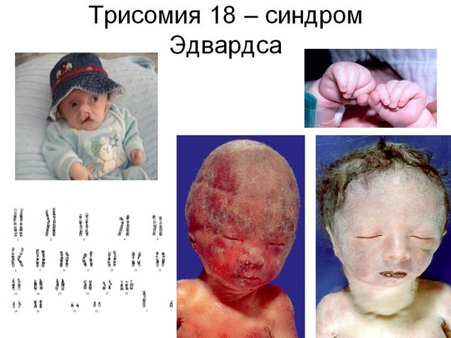 Фото больного с синдромом эдвардса