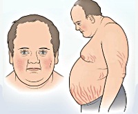 Стероидный сахарный диабет