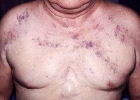 Синдром верхней полой вены