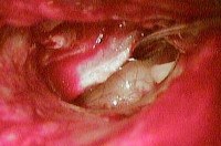 Хронический гнойный средний отит