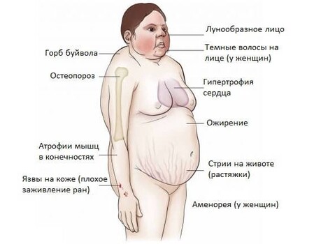 Синдром лица в форме полной луны