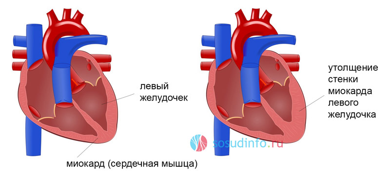 Синдром спортивного сердца у подростков