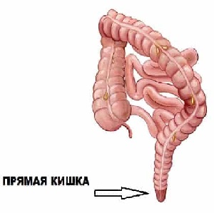 Чем опасна язва прямой кишки: как распознать по симптомам и методы лечения