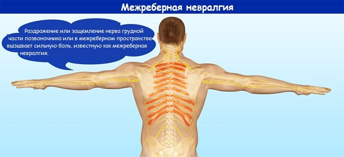 Что такое межреберная невралгия