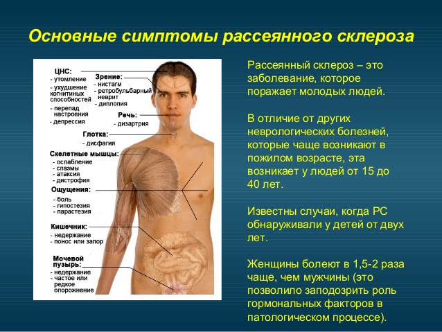Симптомы рассеянного склероза