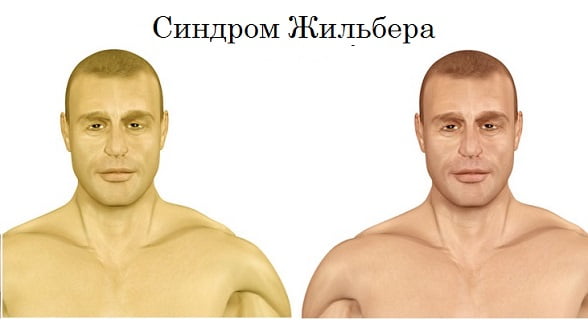 Синдром жильбера на генетическом уровне
