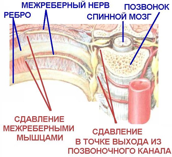 Защемление нерва в грудном отделе при межреберной невралгии