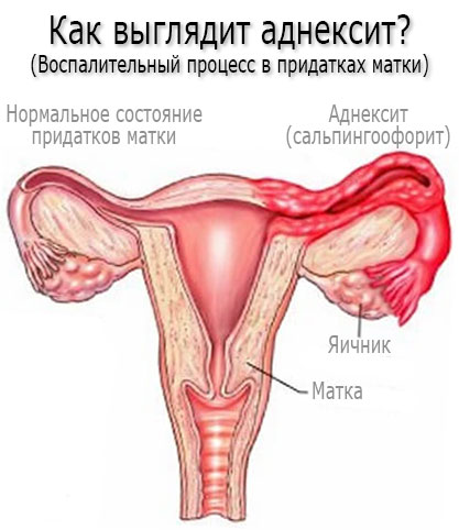 Как выглядит аднексит? Симптомы аднексита (сальпингоофорита)