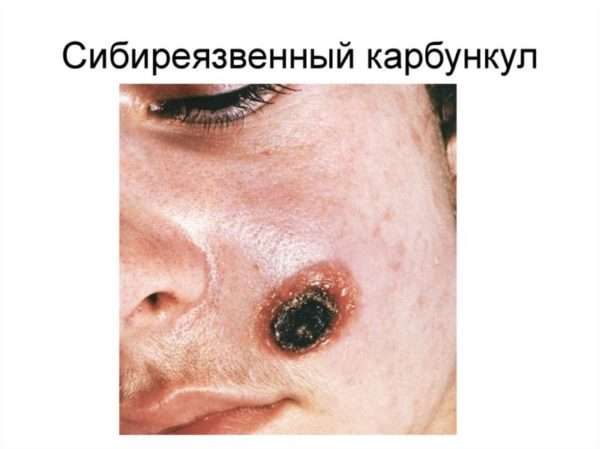 Код по мкб фурункул стопы