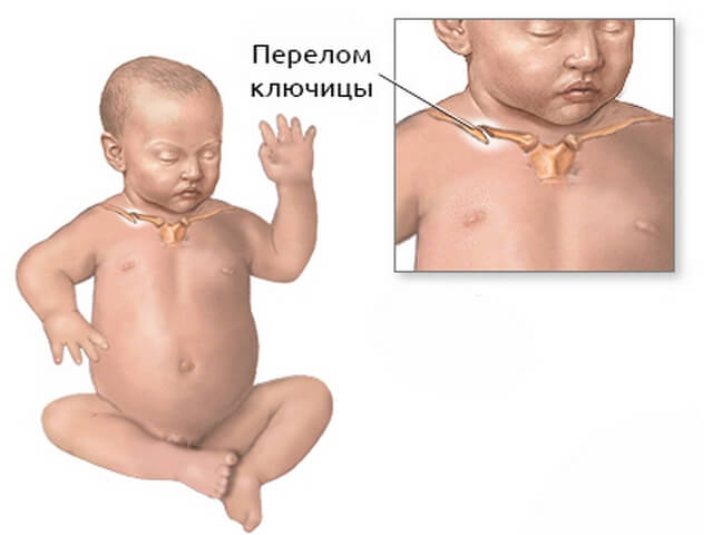 Перелом ключицы новорожденного код мкб