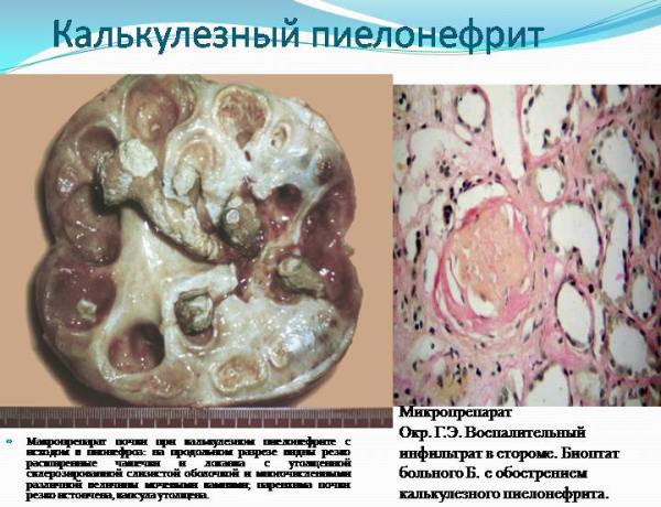 Патогенез, причины и формы калькулезного пиелонефрита