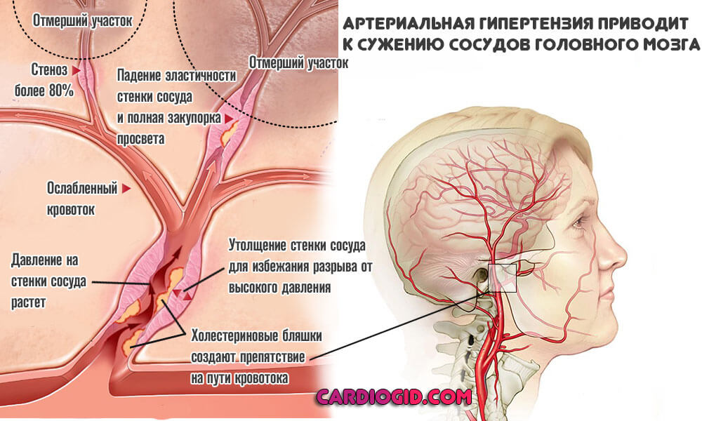 Острая энцефалопатия синдром гипертензии стадия субкомпенсации