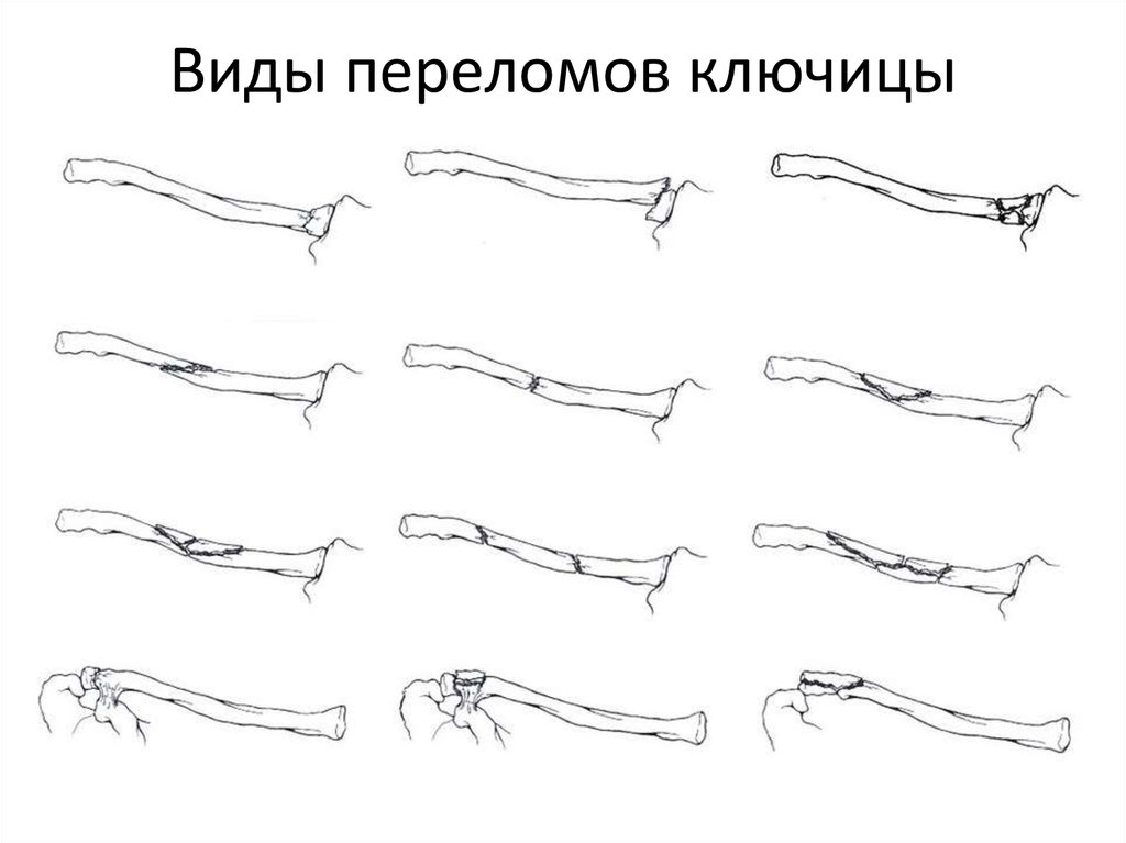 Перелом ключицы новорожденного код мкб